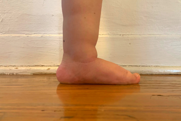 An example of a flat foot