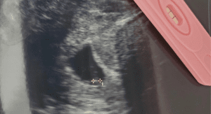 Sonogram image next to a pregnancy test