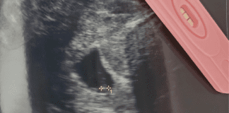 Sonogram image next to a pregnancy test