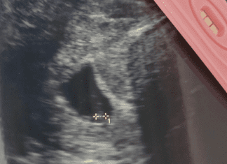 Sonogram image next to a pregnancy test